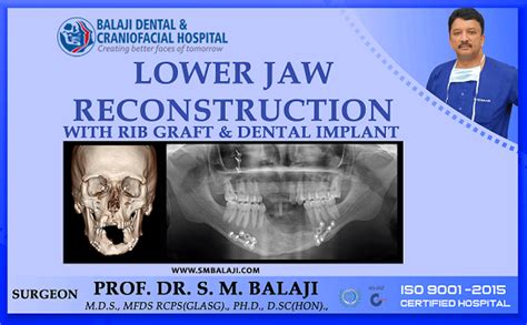 Jawbone Biomaterial: Revolutionizing Craniofacial Reconstruction and Dental Implantation!